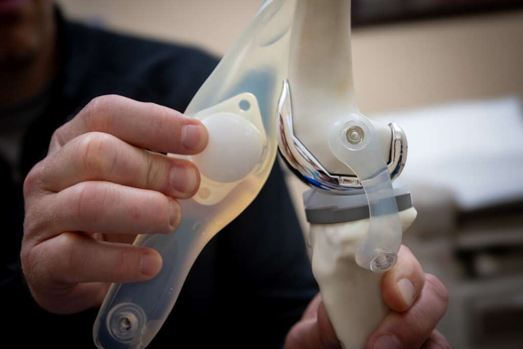 Medical professional demonstrating knee joint replacement model showing artificial joint implant