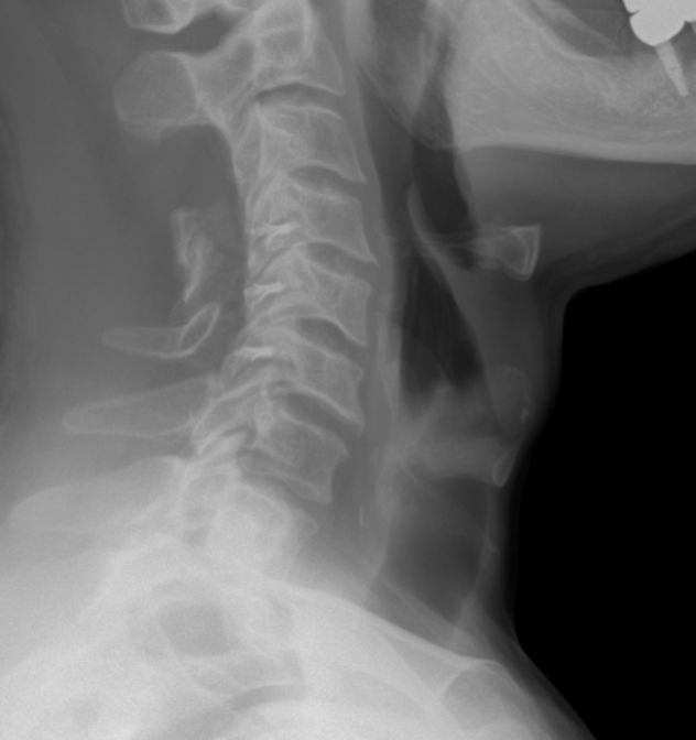 Lateral view X-ray of the neck showing the cervical spine from C1 to C7 with surrounding soft tissues.