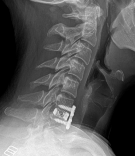 Lateral X-ray of the neck showing cervical vertebrae with posterior fusion hardware (pedicle screws and plate) at the lower cervical spine.