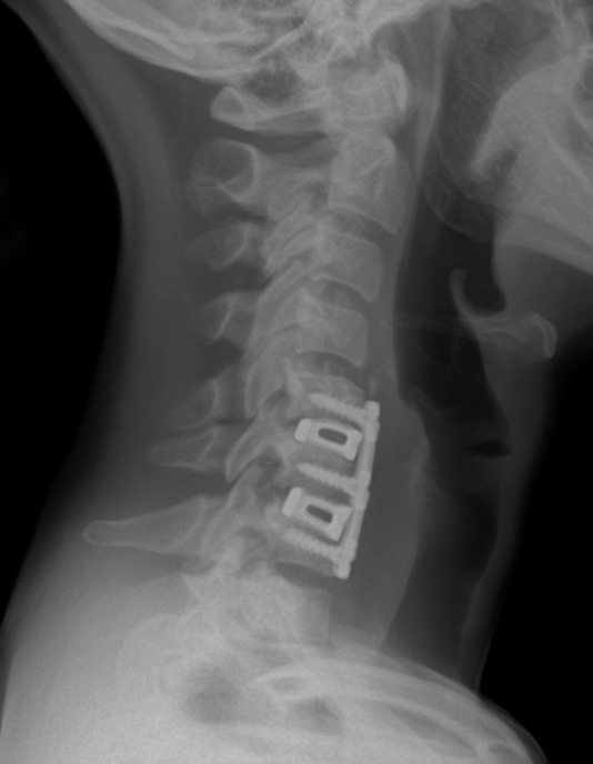Lateral cervical spine X-ray showing posterior fusion hardware (screws and plates) across several vertebrae.