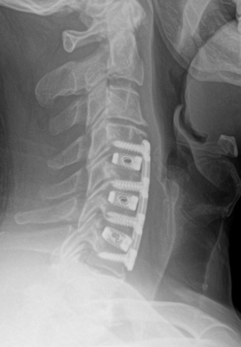 Lateral X-ray of the cervical spine showing posterior spinal fusion hardware with screws along the vertebrae C3–C6/7.