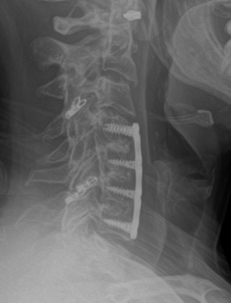Lateral X-ray of the neck showing posterior cervical fusion with screws and a plate along the spine.