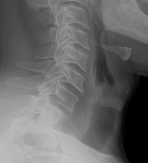 Lateral view X-ray of the neck showing cervical vertebrae and surrounding soft tissues.