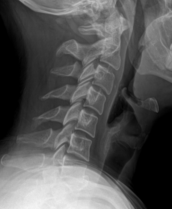 Lateral X-ray of the neck showing the cervical spine from skull base to upper thoracic region.