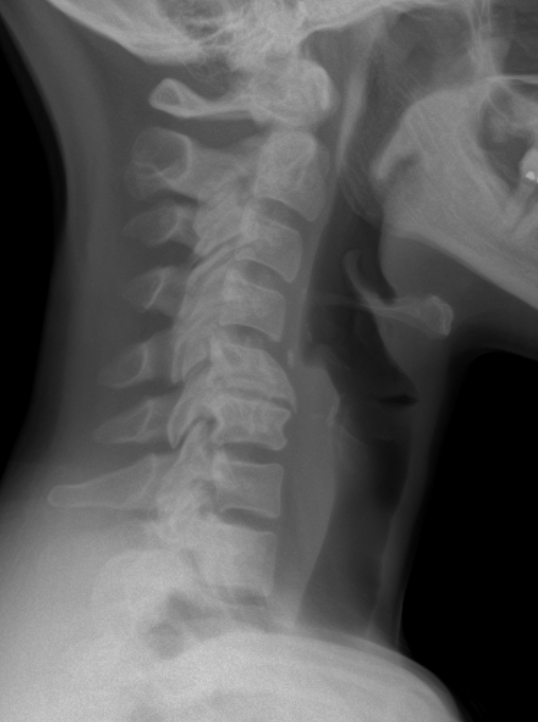 Lateral X-ray of the neck showing cervical vertebrae from C1 to C7 and their alignment.