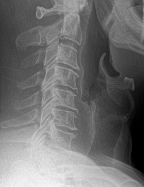 Lateral X-ray of the neck showing cervical vertebrae and disc spaces.