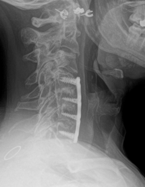 Lateral neck X-ray showing a cervical spine fusion with a vertical plate and multiple screws from C3 to C6/7 (anterior cervical plating).