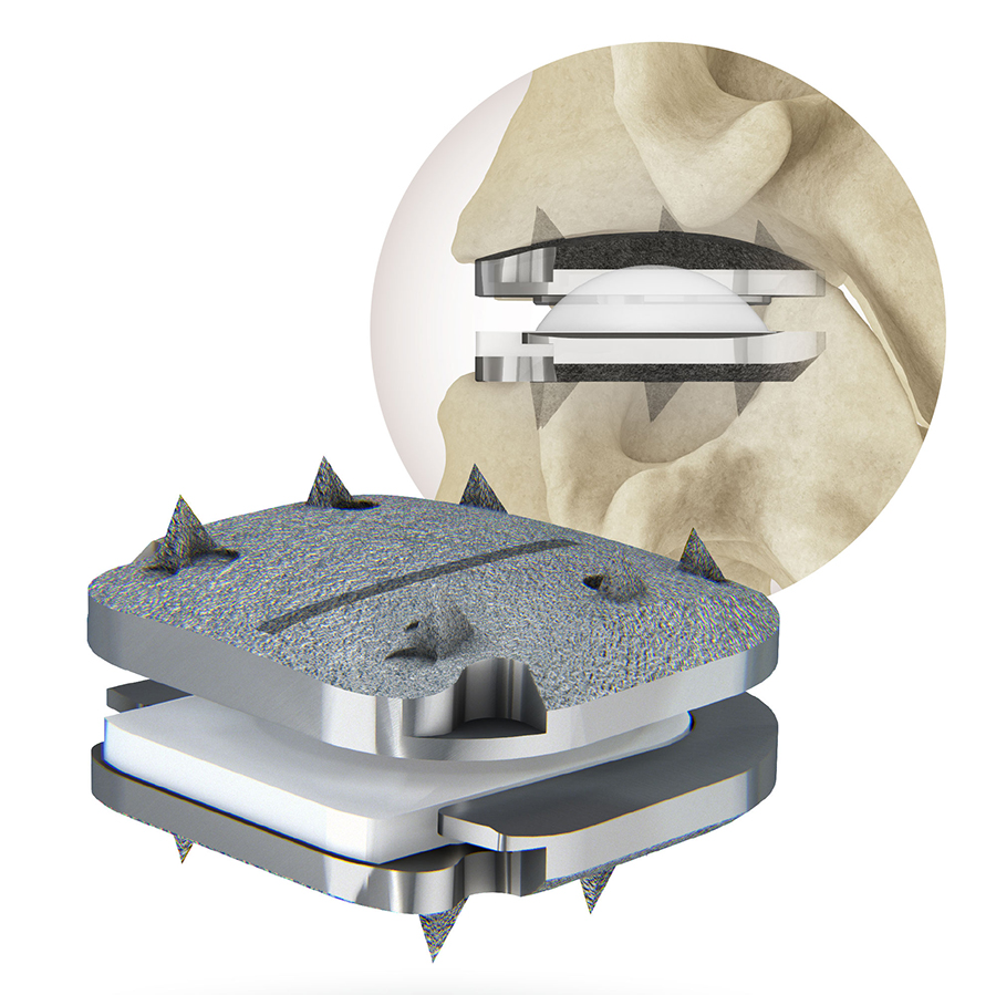 TDR - Barbour Orthopaedics & Spine 3D render of a modular orthopedic joint implant with titanium components and spacers, shown with a bone cross-section in the background
