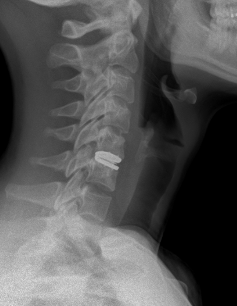 after - Barbour Orthopaedics & Spine Lateral X-ray of the neck showing cervical vertebrae with a small metallic spinal implant at the mid-cervical level.