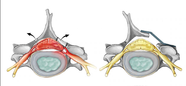 Two cross‑sectional views of a lumbar spinal disc with nerve roots: left shows red herniation compressing the root with arrows indicating movement; right shows a surgical instrument retracting the nerve and decompressing the canal.