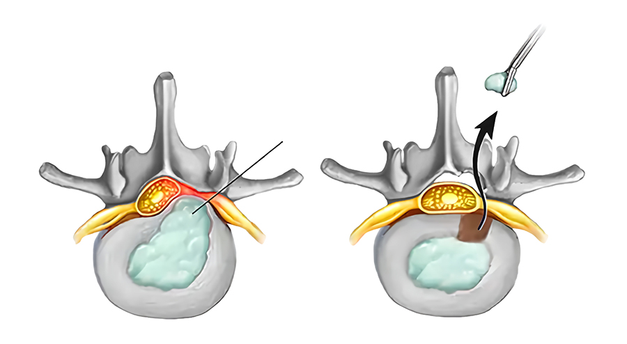 Left: cross-section of a lumbar spinal disc showing a herniation pressing on a nerve root (red area). Right: surgical removal of the herniated disc material with a tool, relieving pressure on the nerve.