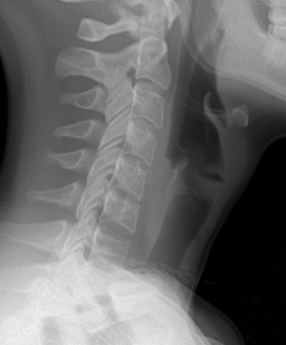 before - Barbour Orthopaedics & Spine Lateral X-ray of the neck showing the cervical spine from skull base to upper thoracic region, illustrating vertebrae alignment and intervertebral discs.