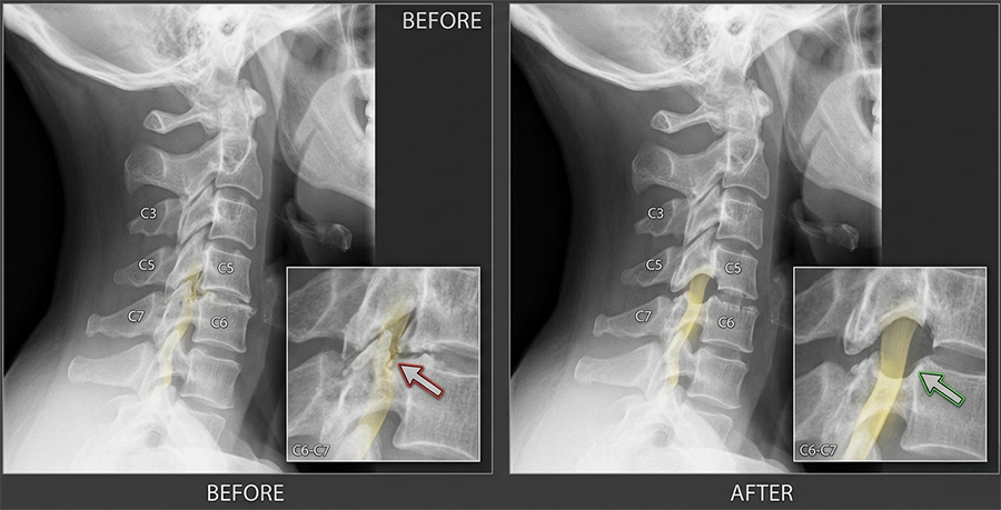 Side-by-side cervical spine X-rays labeled BEFORE and AFTER, with insets highlighting the C6–C7 area (red arrow before, green arrow after).