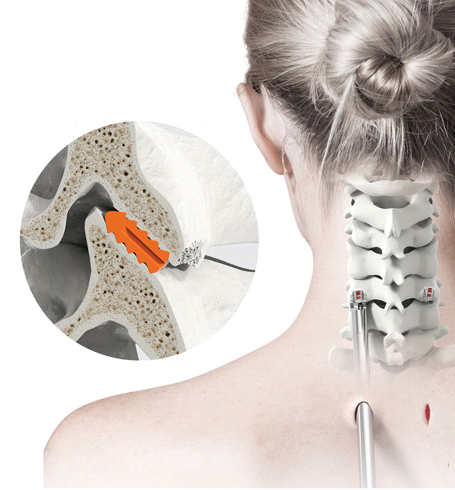 Medical illustration of the cervical spine showing an orange intervertebral spacer between vertebrae in the neck area with surgical tools nearby and a person’s neck in the background.