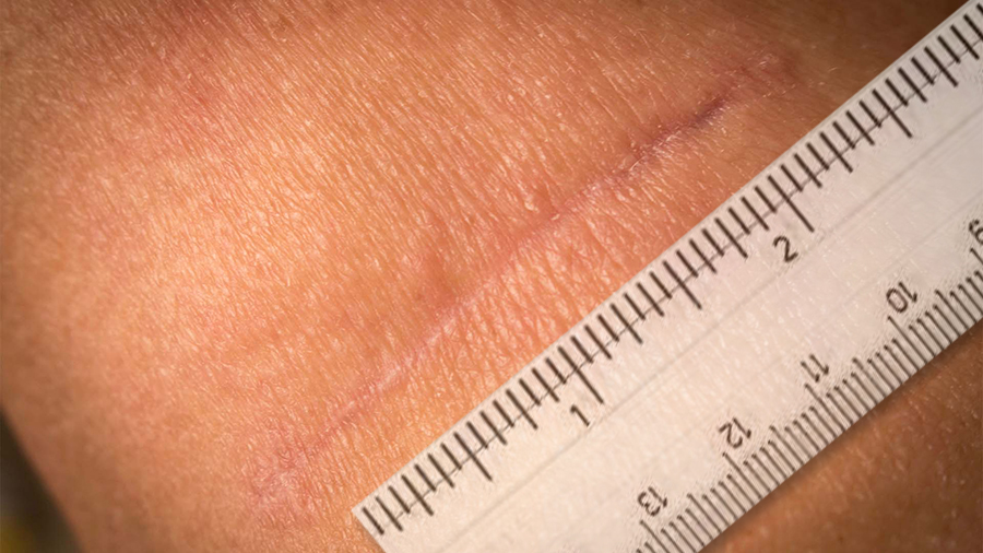 Close-up of light brown skin with a diagonal healed scar next to a centimeter ruler for measurement.