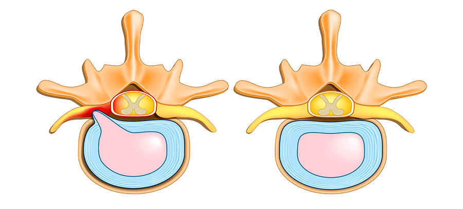 Comparison of a herniated disc (left) and a normal intervertebral disc (right) in a spine cross-section.