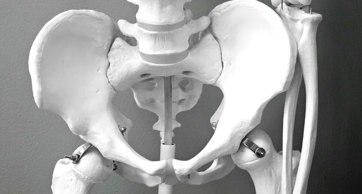 An anatomical skeleton model of the pelvis and lower spine with metallic rods and clamps attached.