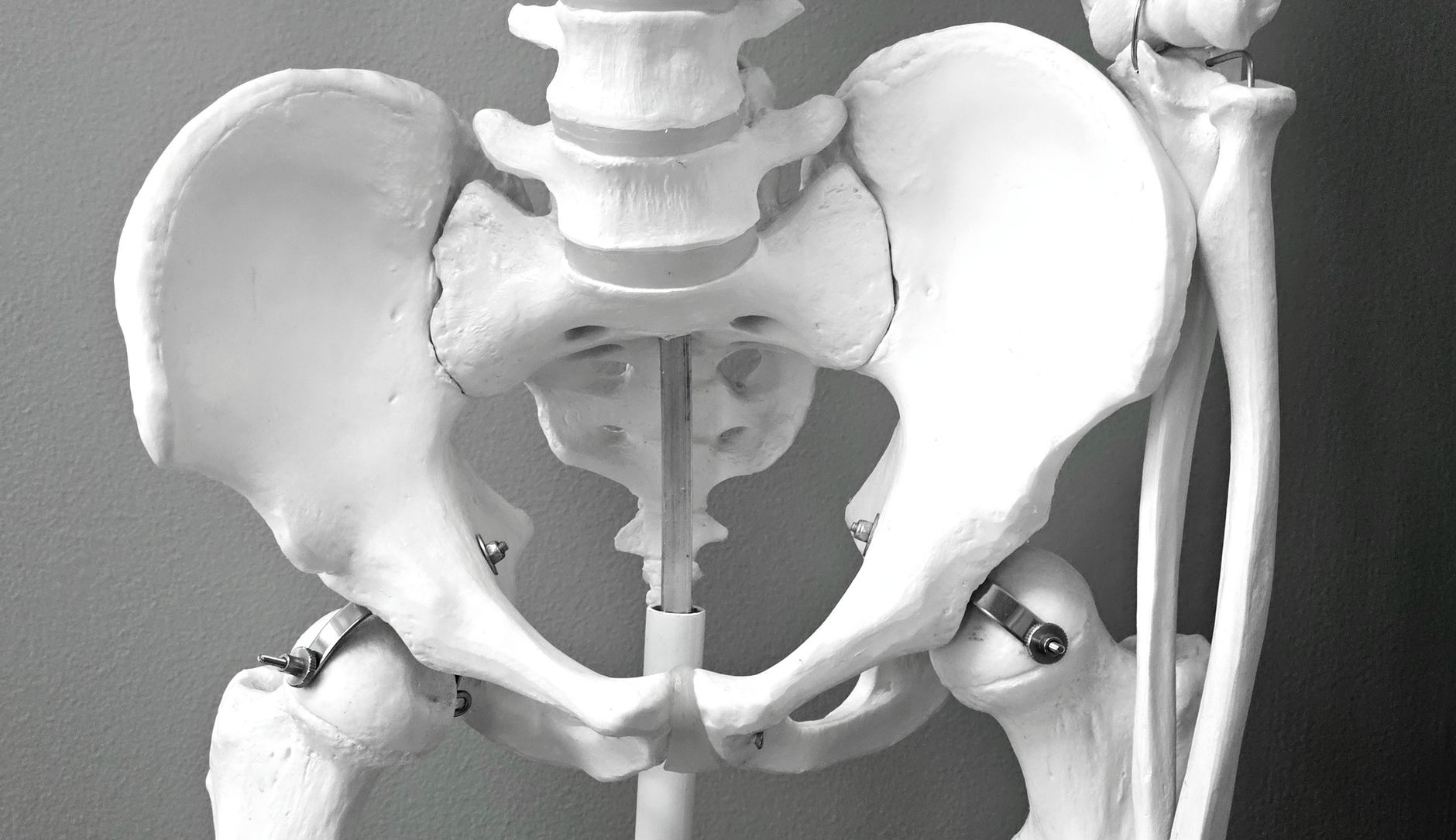 An anatomical skeleton model of the pelvis and lower spine with metallic rods and clamps attached.