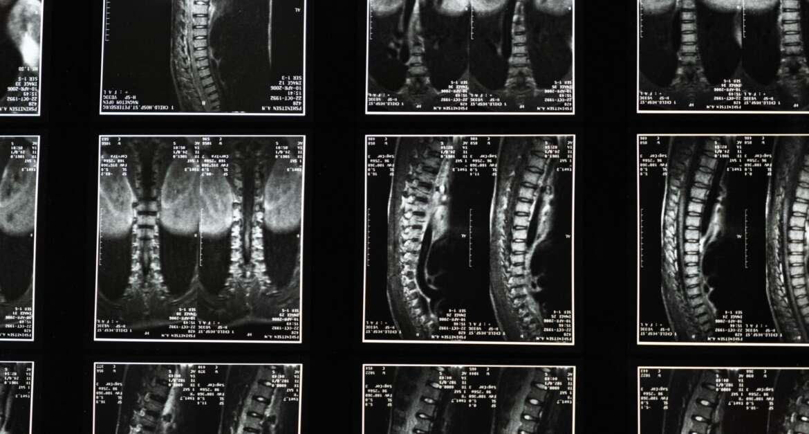 Comprehensive spinal MRI images used for back pain diagnosis and treatment planning
