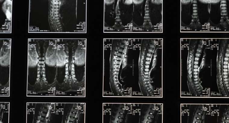 Finding the Right Back Pain Doctor in Sandy Springs: Your Complete Guide