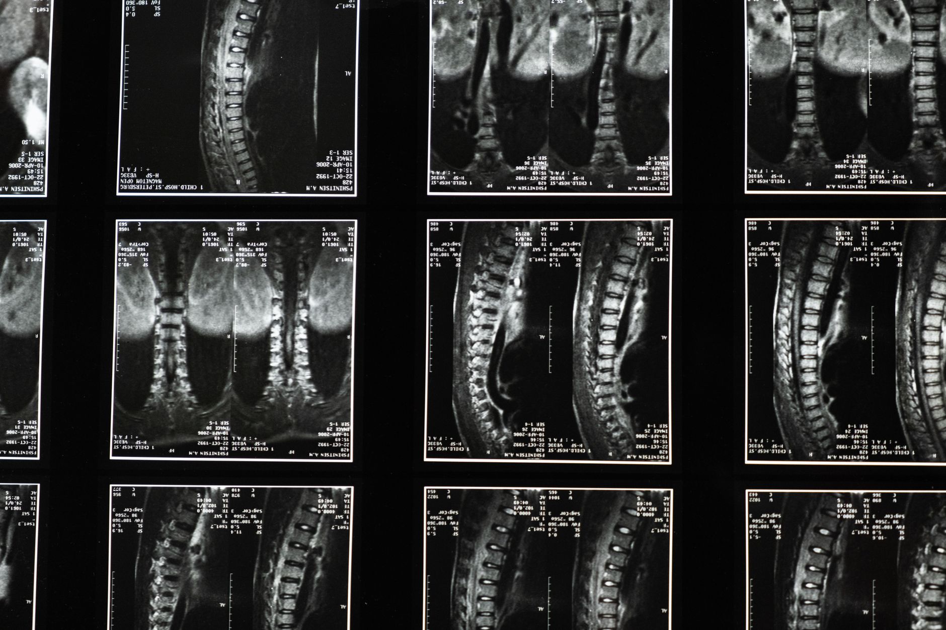 Comprehensive spinal MRI images used for back pain diagnosis and treatment planning