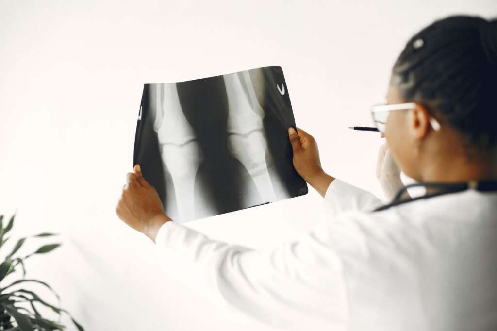 Doctor examining a knee X-ray to determine if a patient needs knee replacement surgery