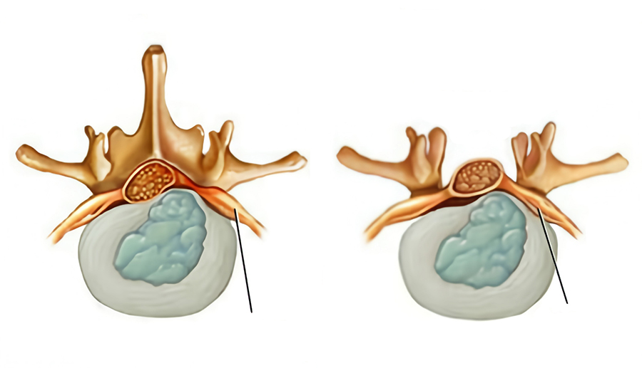 Side-by-side spinal disc cross-sections: left shows a herniated disc bulging outward, right shows a normal disc for comparison