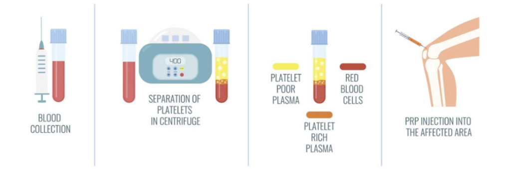 Step-by-step PRP treatment: blood draw, centrifuge separation of platelets, PRP injection into the affected area (e.g., knee).